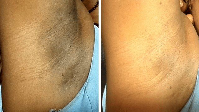 Como-Clarear-as-Axilas-e-Virilhas-Rapidamente