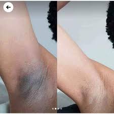 Antes e depois Cicatridiva