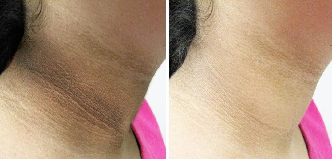 Antes e depois Cicatridiva