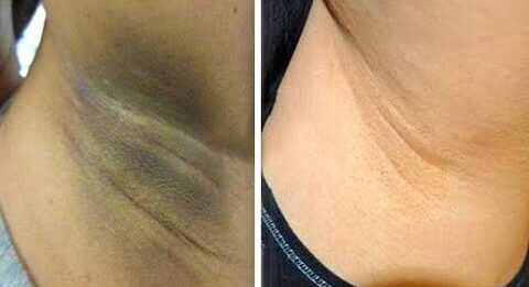 Antes e depois Cicatridiva